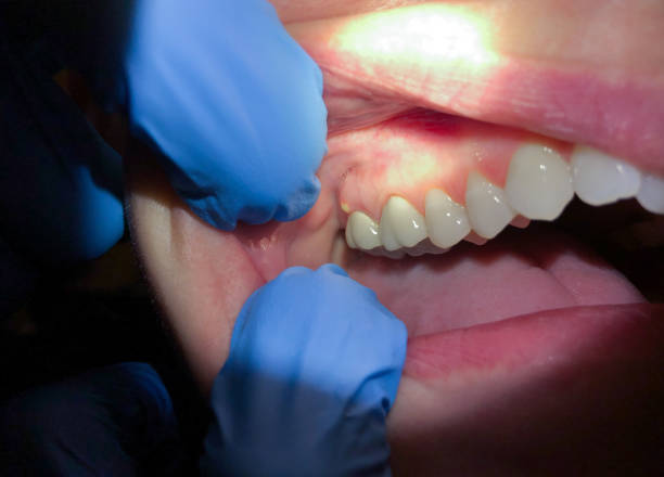 Best Emergency Dental Care for Broken or Chipped Teeth in Moosic, PA